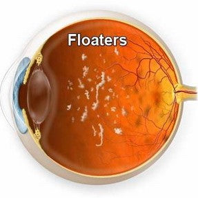 What Causes Floaters in the Eye?
