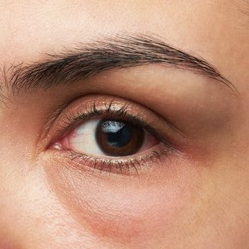 How to Get Rid of Under-Eye Bags